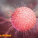 herpes zóster